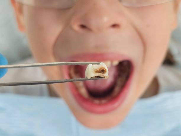 Best Emergency Root Canal Treatment in North Liberty, IN